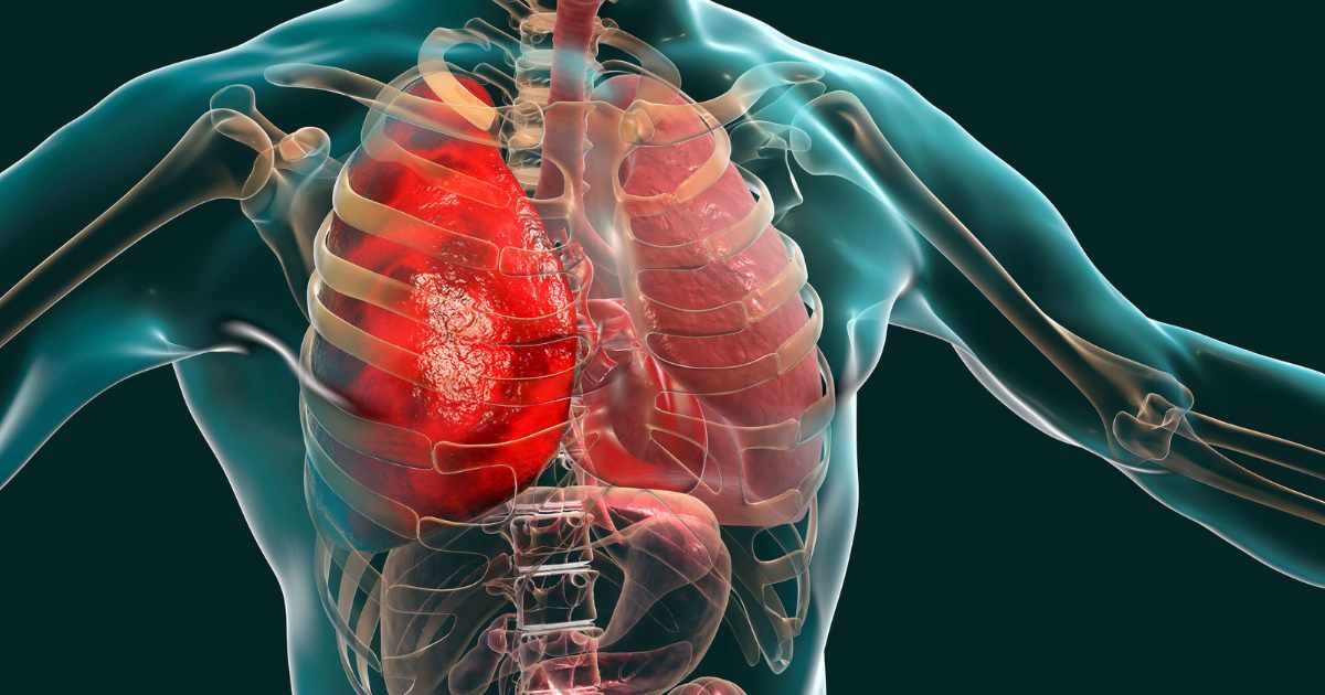 Bronchitis and Pneumonia