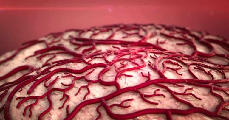 Brain Bleed